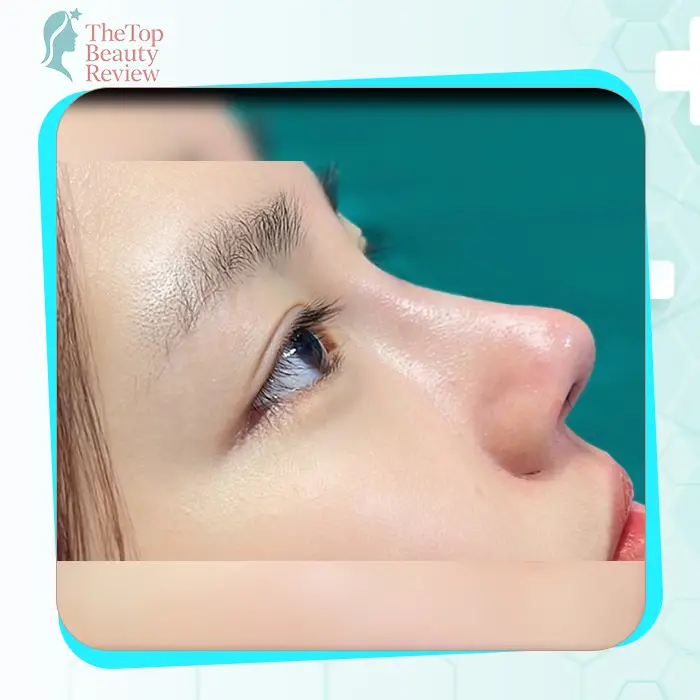 Khám phá 7+ Phòng khám phẫu thuật nâng mũi uy tín và được đánh giá cao nhất tại An Giang