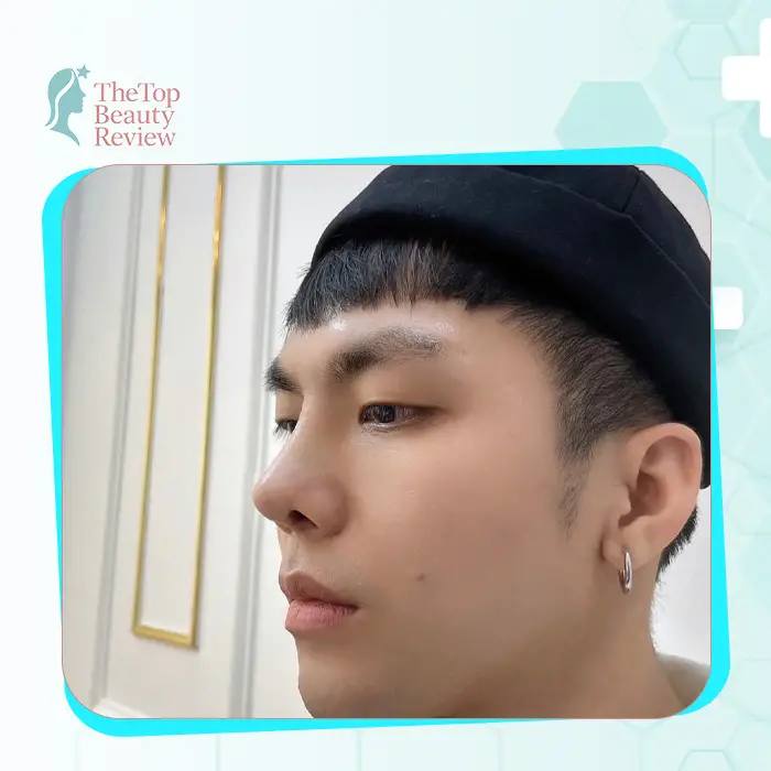 Discover the Top 7 Reputable and Professional Rhinoplasty in Sóc Trăng