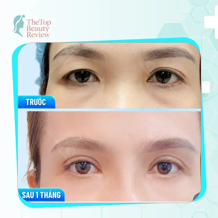 Top 7 Blepharoplasty in Vietnam: Reputable & High-Quality