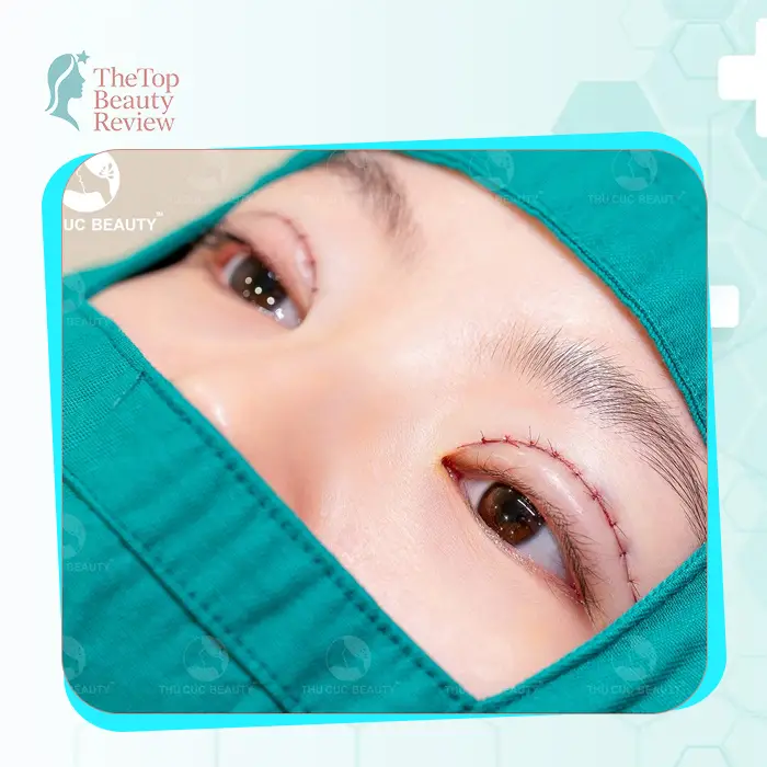 Top 7 Blepharoplasty in Vietnam: Reputable & High-Quality