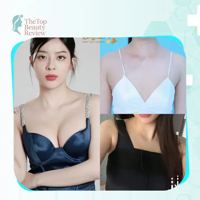 Breast Augmentation in Lam Dong: Where to Get It? Top 6+ Trusted Places Many Women Are Interested In