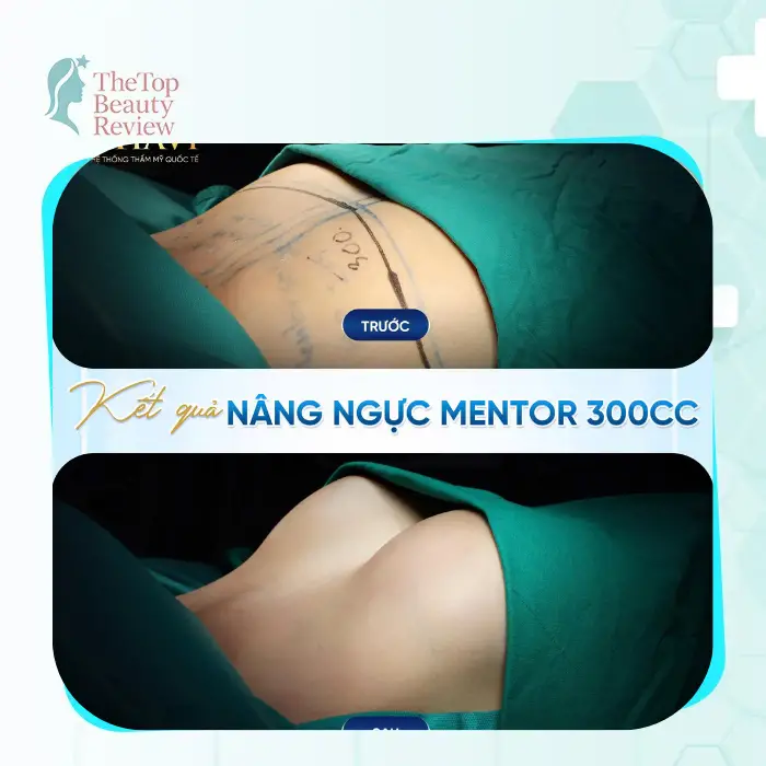 Top 4 Beauty Clinics for Breast Augmentation in Nghe An